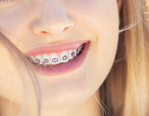 Orthodontie de l’adolescent 